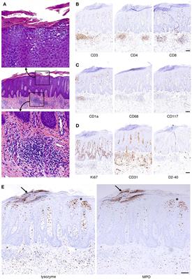 The Interleukin-23/Interleukin-17 Axis Links Adaptive and Innate Immunity in Psoriasis